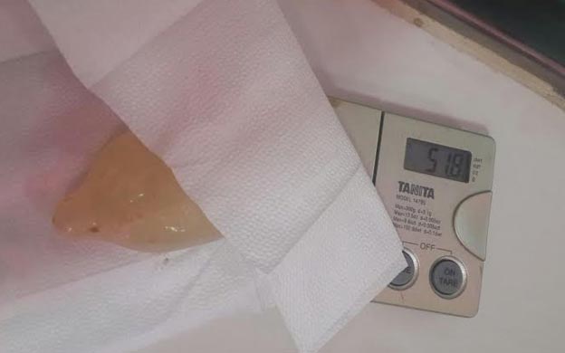 La mujer tuvo que ser atendida de emergencia luego que se reventara uno de los dediles que llevaba en el estu00f3mago. (Foto: Prensa)