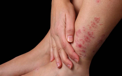 Mitos y realidades de la psoriasis