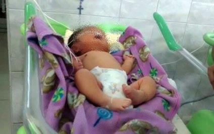 Nace en Perú niño con dos narices