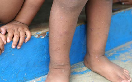 Repuntan casos de escabiosis por escasez de agua y jabón