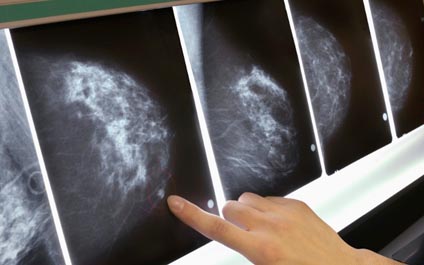 Fármaco reduce expansión del cáncer de mama