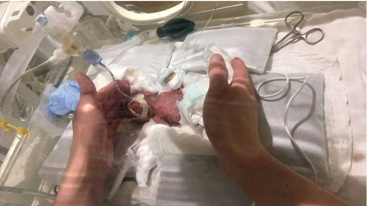 Nace el bebé más pequeño del mundo 