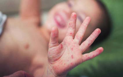 OPS: Van 73 muertes por sarampión en 2018 en el país  
