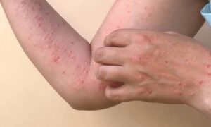 Gobierno activa plan de vigilancia epidemiológica contra la viruela del mono