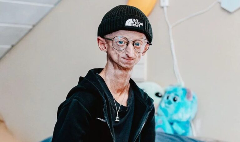 Muere Michiel Vandeweert, el influencer que dio visibilidad a la progeria